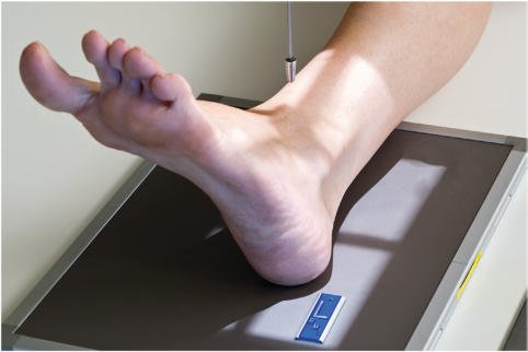 Fig. 6.87 Incidență AP oblică medială la 45°.