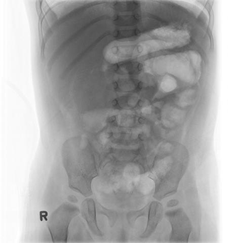 Fig. 16.60 Abdomen AP, decubit dorsal (evidențiază distensia cu aer-