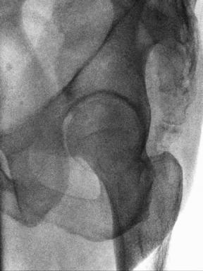 Fig. 7.61 Incidență oblică axială PA (Teufel)—12-