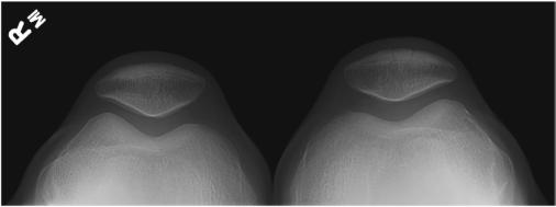 Fig. 6.136 Metoda Merchant — tangențial bilateral. (Cu amabilitatea lui Joss
