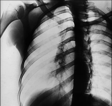 Fig. 10.43 Incidență oblică PA. (Adaptat după Rollins J, Long B,
