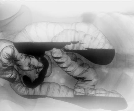 Fig. 13.81 Decubit lateral stâng.
