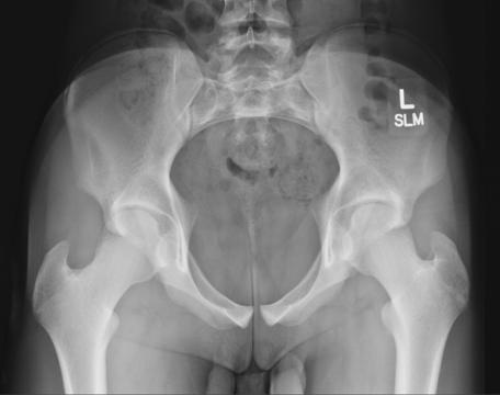 Fig. 7.52 Incidență AP axială de intrare.