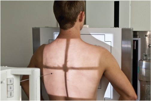 Fig. 10.36 Coaste (grilaj costal) PA bilateral — deasupra cupolelor diafragmatice.
