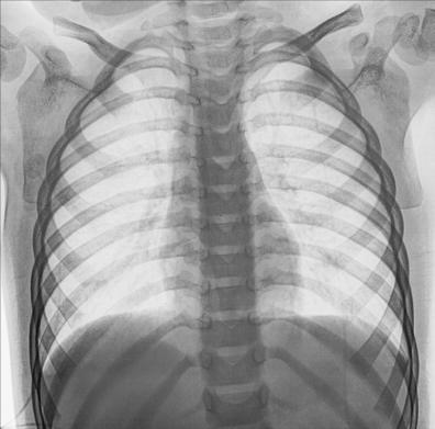Fig. 10.37 Coaste (grilaj costal) PA bilateral — deasupra cupolelor diafragmatice.