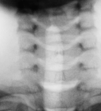 Fig. 2.89 AP—căi aeriene superioare.