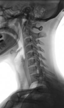 Fig. 2.88 Profil—căi aeriene superioare.