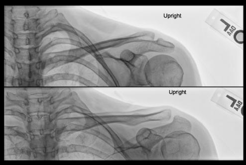 Fig. 5.89 AP axială claviculă—raza centrală 15° până la 30° cranial.