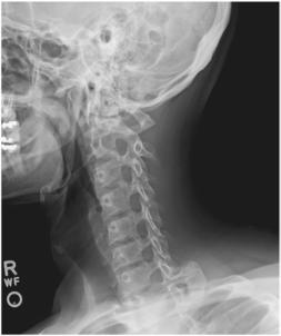 Fig. 8.54 Oblică posterioară dreaptă.
