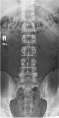 Fig. 9.29 Incidență lombară AP (centrată pentru 14 × 17-