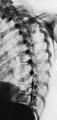 Fig. 8.89 RAO toracal