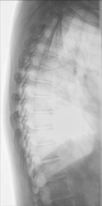 Fig. 8.84 incidență de profil a coloanei toracale