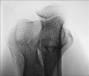 Fig. 4.133 humerus distal.