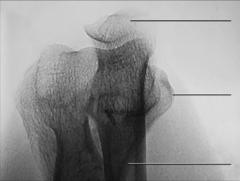 Fig. 4.131 humerus distal.