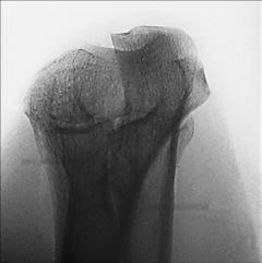 Fig. 4.134 antebraț proximal.