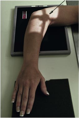 Fig. 4.148 Decubit dorsal, înclinat la 45° pentru