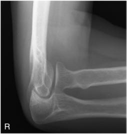 Fig. 4.150 pentru capul radial.