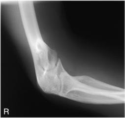 Fig. 4.152 axială latero-medială