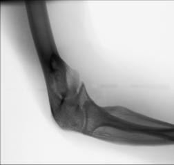 Fig. 4.151 pentru procesul coronoid.