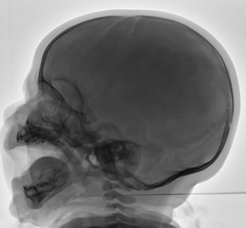 Fig. 16.58 craniu lateral. (Caz oferit cu amabilitate de Dr. Ian Bickle,