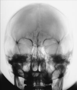 Fig. 11.115 PA axială—15° caudal (incidență occipito-frontală (metoda Caldwell)).