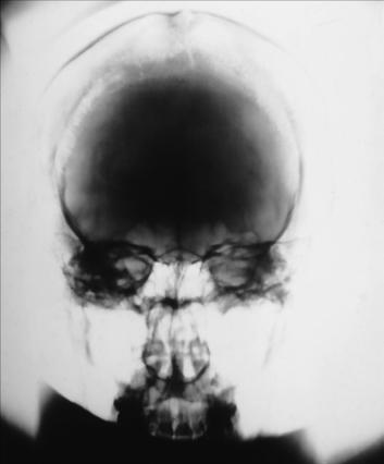 Fig. 11.117 PA craniu.