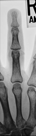 Fig. 4.37 PA—falanga a patra.