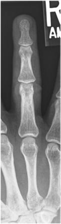 Fig. 4.38 PA—falanga a patra.