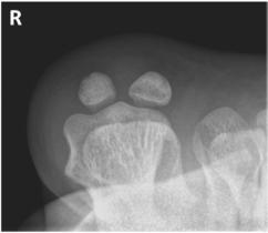 Fig. 6.52 Incidență tangențială — pacient în decubit ventral.