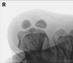 Fig. 6.53 Incidență alternativă — pacient în decubit dorsal.