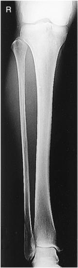 Fig. 6.99 AP gambă —