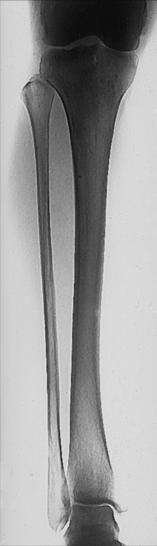 Fig. 6.98 AP gambă — include ambele articulații.