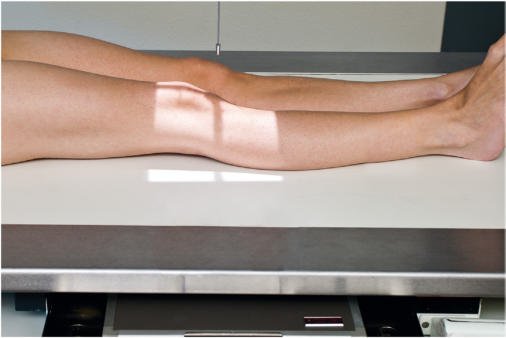 Fig. 6.103 Genunchi AP—raza centrală (RC) perpendiculară pe receptorul de imagine (pacient mediu—19 la