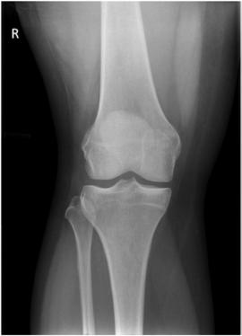 Fig. 6.104 Genunchi AP—raza centrală 0°. (Cu amabilitatea lui Joss Wertz, DO.)
