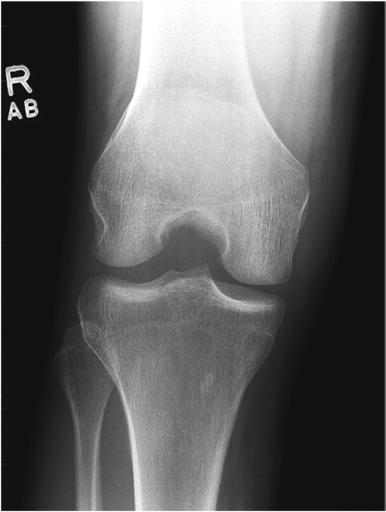 Fig. 6.129 AP axial—flexie 40° și unghiul razei centrale.