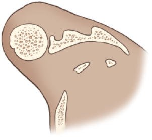 Fig. 5.61 Incidență AP oblică (metoda Grashey).
