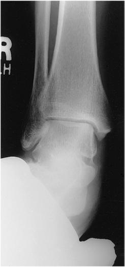 Fig. 6.97 Stres prin eversiune.