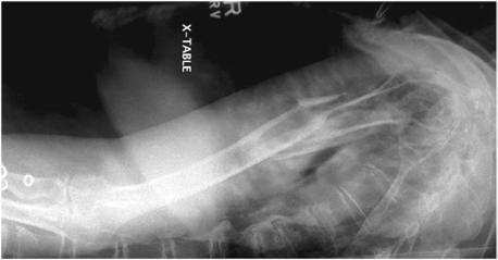 Fig. 5.39 Incidență transtoracică de profil (lateral) a humerusului în decubit.