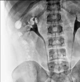 Fig. 14.73 IVU; 10 minute după injectare. (Caz oferit prin amabilitatea Dr MT