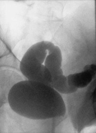 Fig. 13.86 AP axial oblic (LPO).