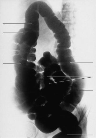Fig. 13.69 poziție oblică anterioară stângă (OAS / LAO).