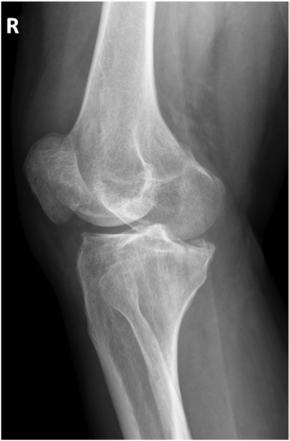 Fig. 6.111 Incidență AP oblică laterală. (Cu permisiunea lui Joss Wertz, DO.)