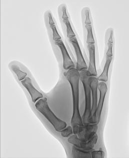 Fig. 4.73 Mână, incidență PA oblică (falangele