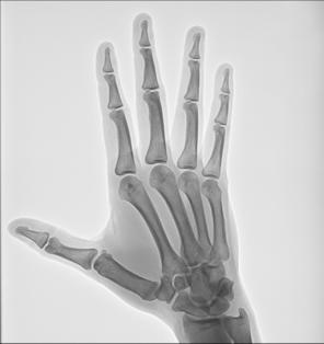 Fig. 4.74 Mână, incidență PA oblică (falangele sunt paralele).