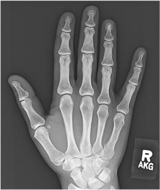 Fig. 4.68 Mână, incidență PA.