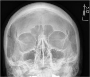 Fig. 11.135 Incidență parieto-acantială modificată—lMl perpendicular