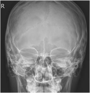 Fig. 11.134 PA axială Caldwell—raza centrală 15°. (Modificat de la Curtis T: