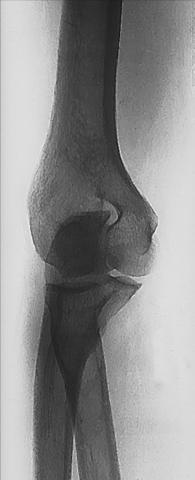 Fig. 4.140 Incidență finală, evidențiind 45° medial