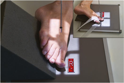 Fig. 6.43 rotație oblică medială — prima falangă.