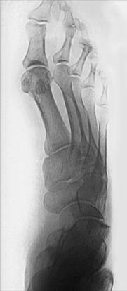 Fig. 6.59 AP oblic medial la 30° până la 40°.